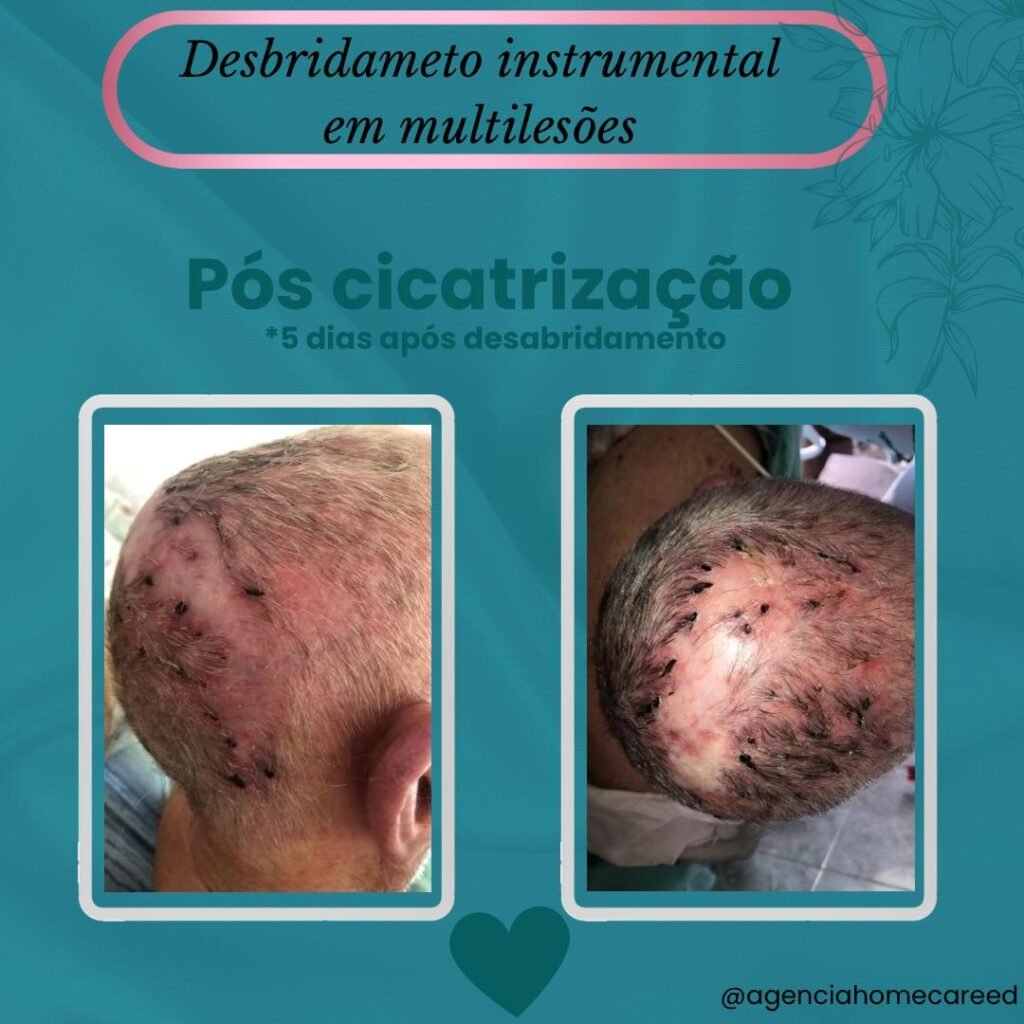 PÓS CICATRIZAÇÃO - Desbridamento Instrumental em multi lesões